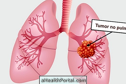 Top 10 symptomer på lungekræft