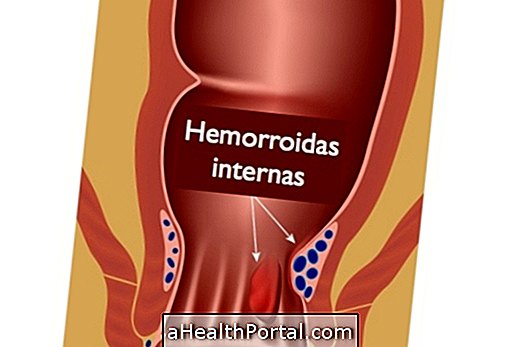 Comment identifier s'il s'agit d'une hémorroïde interne