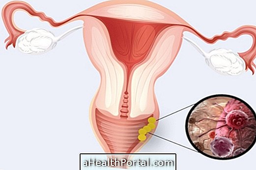 Vaginal kræft: Hvordan man identificerer og hvem har større risiko