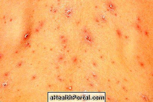 Symptômes de varicelle, traitement, transmission et prévention