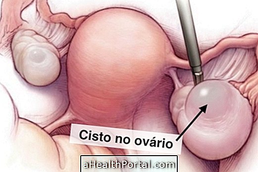 Symptoms of cyst in ovary