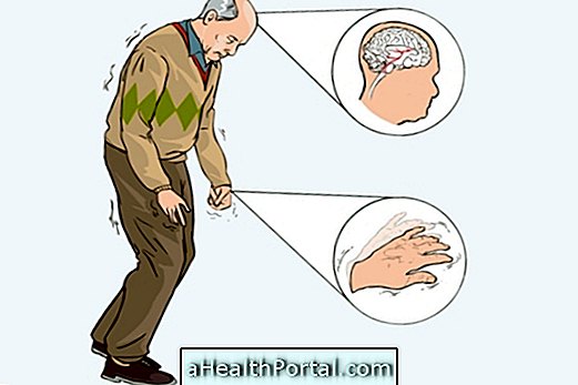 Major tegn og symptomer på Parkinsons