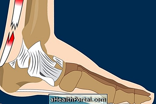 Signs of Achilles tendon rupture