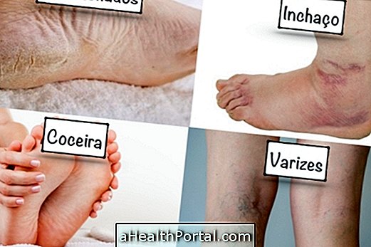 Simptomi loše cirkulacije u nogama