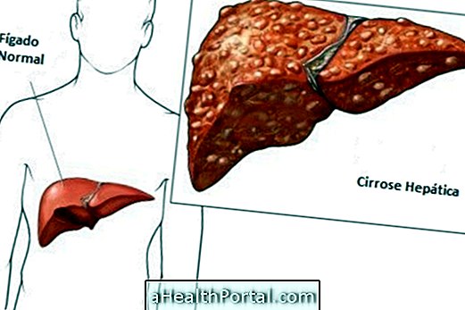 Symptoms of liver cirrhosis