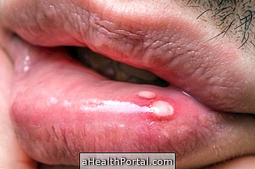 Kend symptomerne på mund- og mundstomatitis