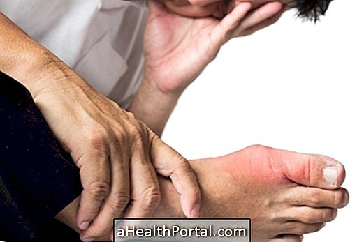 How to Identify the Symptoms of Gout