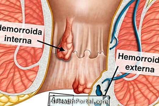 Smerter i anus og blødning kan indikere hæmorider