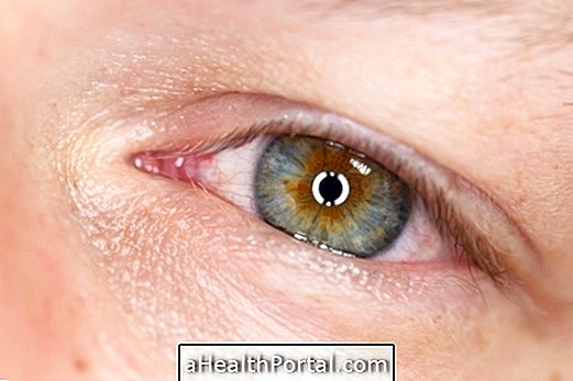 6 galvenie niezes acu cēloņi