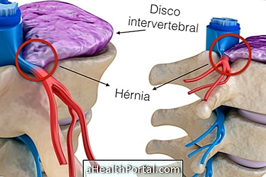 Hoe te weten is een hernia en wat zijn de belangrijkste symptomen