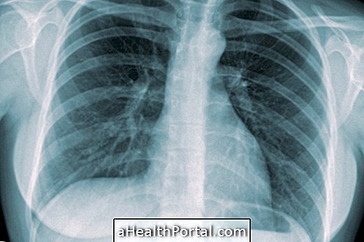 6 Symptome von Tuberkulose
