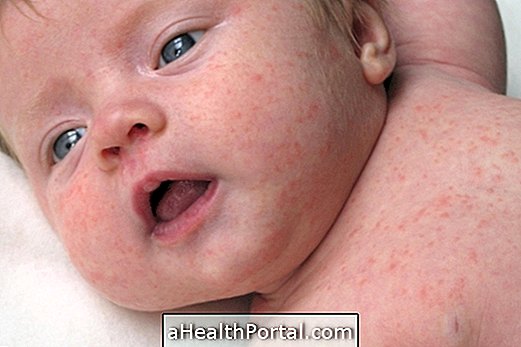 Toiduga allergia märke ja sümptomeid beebis
