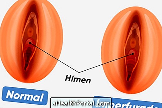 Quel est l'hymen imperforate et comment traiter