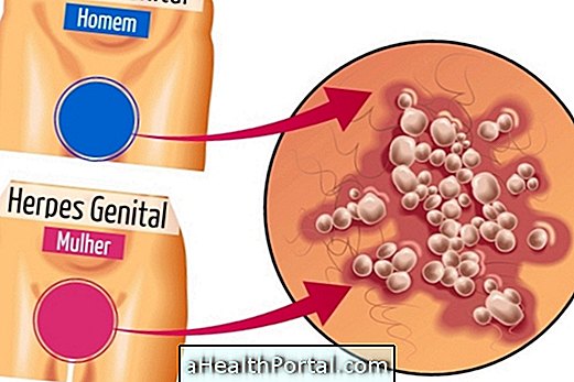 Her er hvordan man identificerer symptomerne på genital herpes