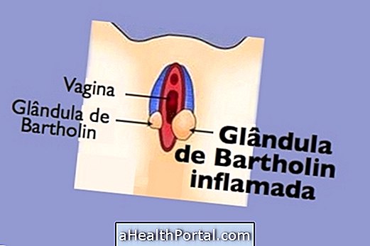 How to treat inflammation of the Bartholin gland