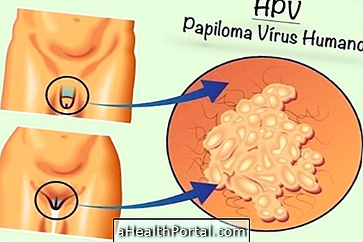 HPV: oireet, siirto, hoito ja hoito