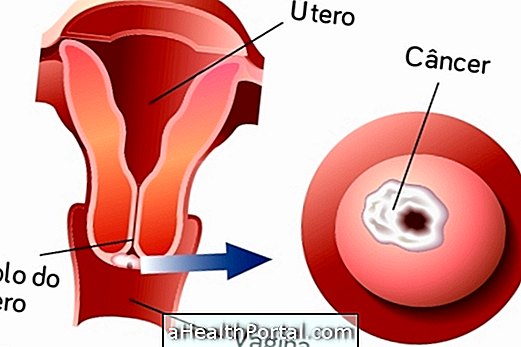 Ursachen von Gebärmutterhalskrebs und wie zu vermeiden