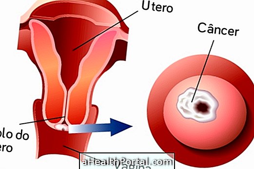 Symptoms of cervical cancer