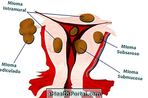 Emaka fibroidide tüübid