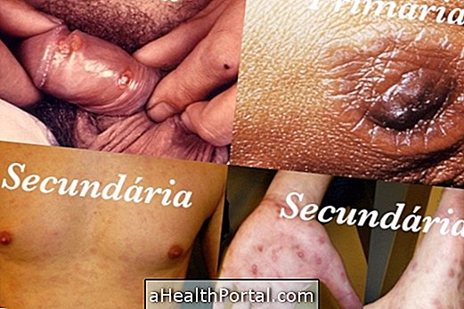 Syfilis: store symptomer (med fotos)