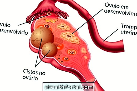 Comment identifier et traiter l'ovaire polykystique