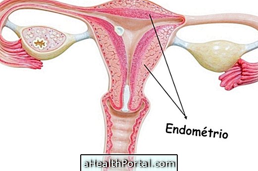 Endometriumin hyperplasia - oireet ja hoito