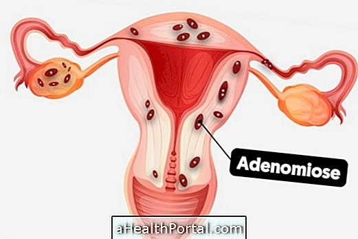 Što je adenomyoza, uzroci i glavni simptomi