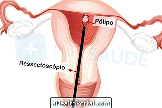Hvornår skal man have kirurgi for at fjerne livmoderen polyp